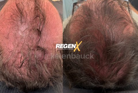 Regen-X