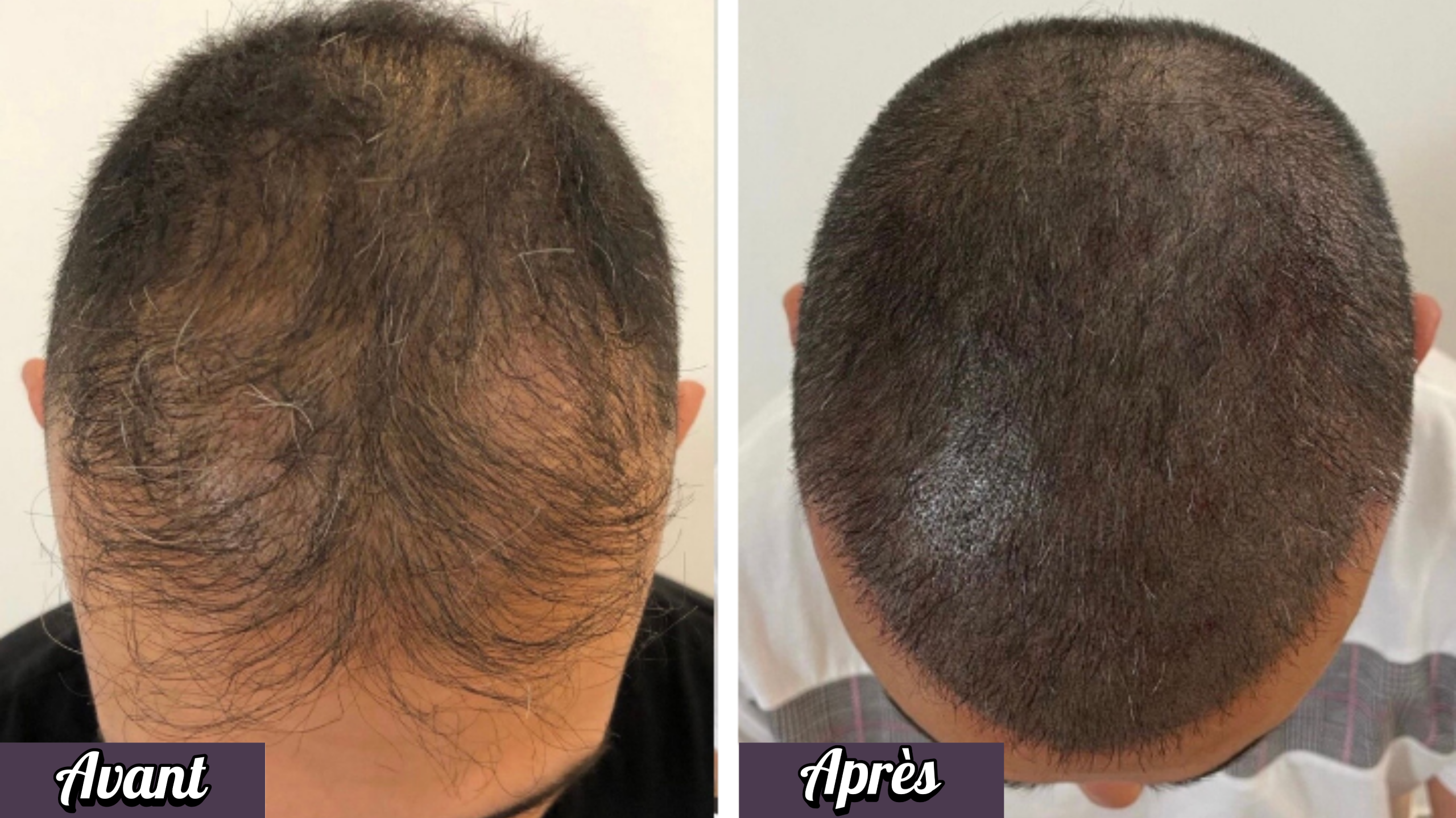 Micropigmentation ou trichopigmentation du cuir chevelu avec effet tête rasée