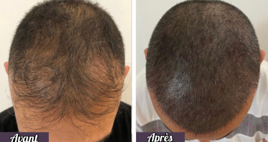 Tricopigmentation capillaire - 1 zone