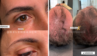 Reconstruction capillaire naturelle avec le protocole RegenX par microstimulation du cuir chevelu