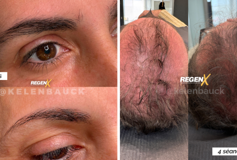Reconstruction capillaire naturelle avec le protocole RegenX par microstimulation du cuir chevelu