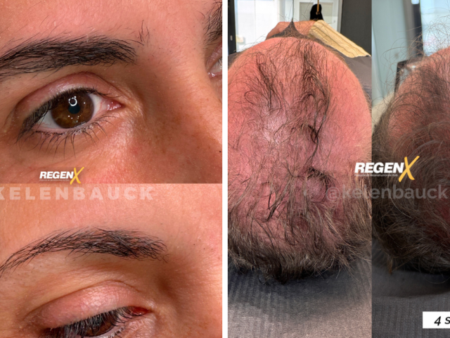 Reconstruction capillaire naturelle avec le protocole RegenX par microstimulation du cuir chevelu