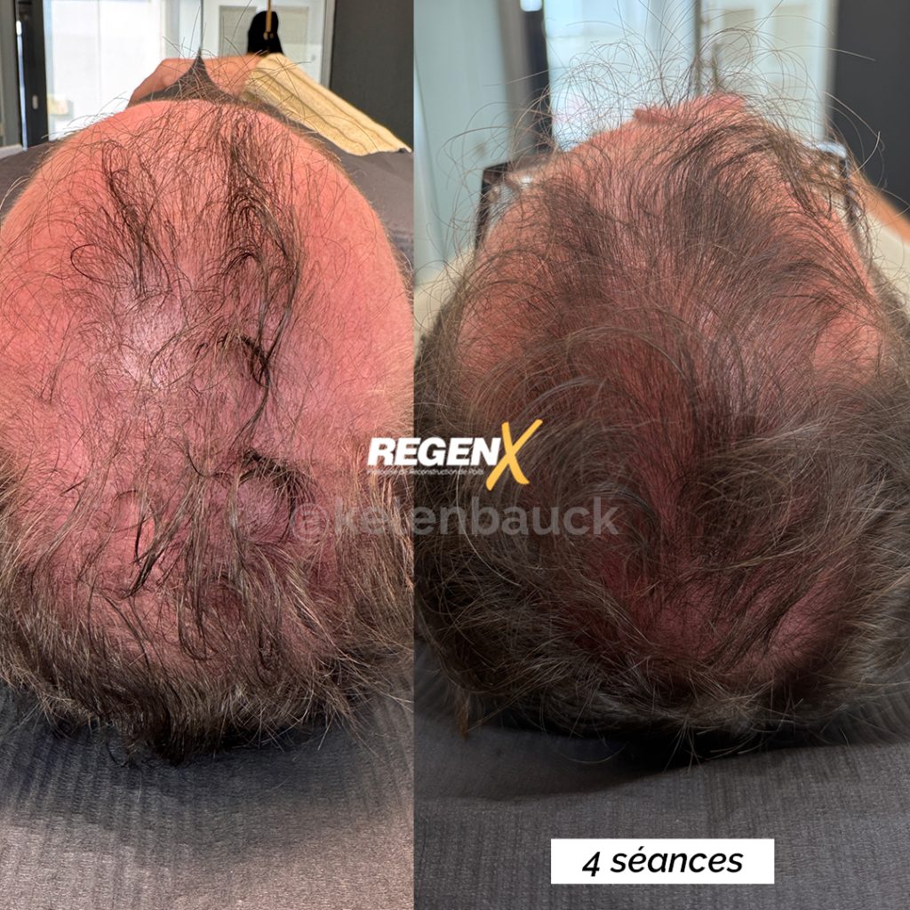 Reconstruction capillaire naturelle avec le protocole RegenX par microstimulation du cuir chevelu