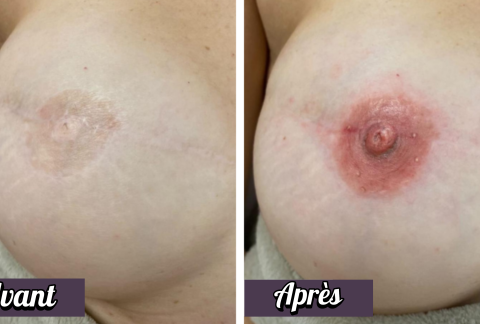 Dermopigmentation réparatrice