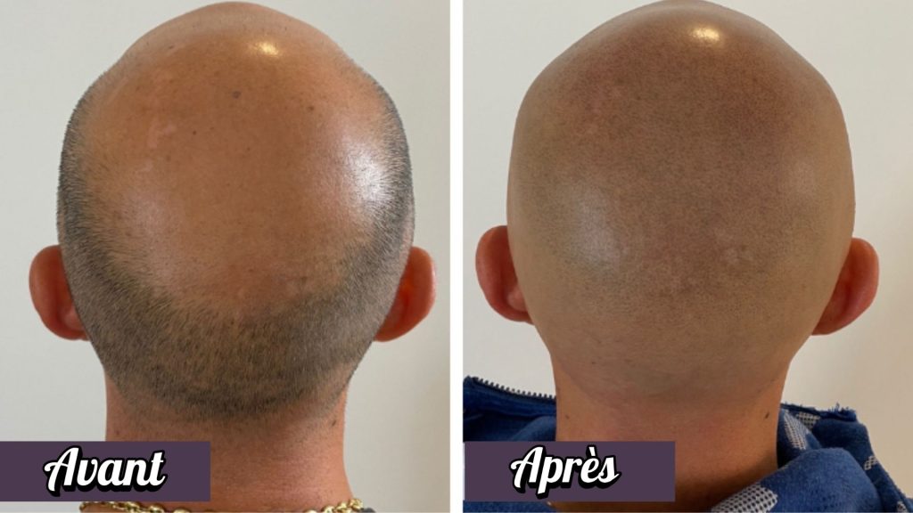 Tricopigmentation avec effet tête rasée
