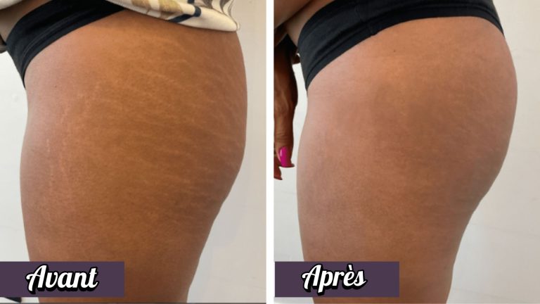 Avant-après d'une dermopigmentation réparatrice pour camouflage de vergetures