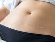 Vue rapprochée d'une cicatrice d'abdominoplastie blanche et stable un an après la chirurgie abdominale.