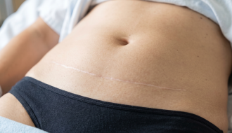 Vue rapprochée d'une cicatrice d'abdominoplastie blanche et stable un an après la chirurgie abdominale.