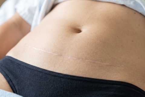 Vue rapprochée d'une cicatrice d'abdominoplastie blanche et stable un an après la chirurgie abdominale.