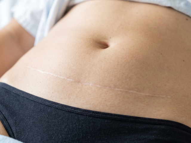 Vue rapprochée d'une cicatrice d'abdominoplastie blanche et stable un an après la chirurgie abdominale.